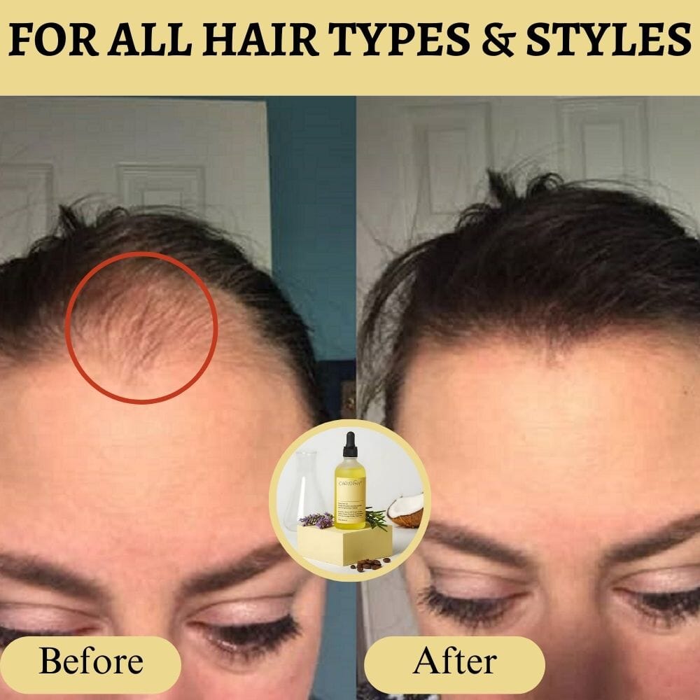 Copie de [50 % OFF] Offical Carvenchy 10+ Natural Anti-Hair Loss Growth Serum Carvenchy